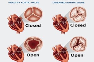 Heart Valve Disease all details