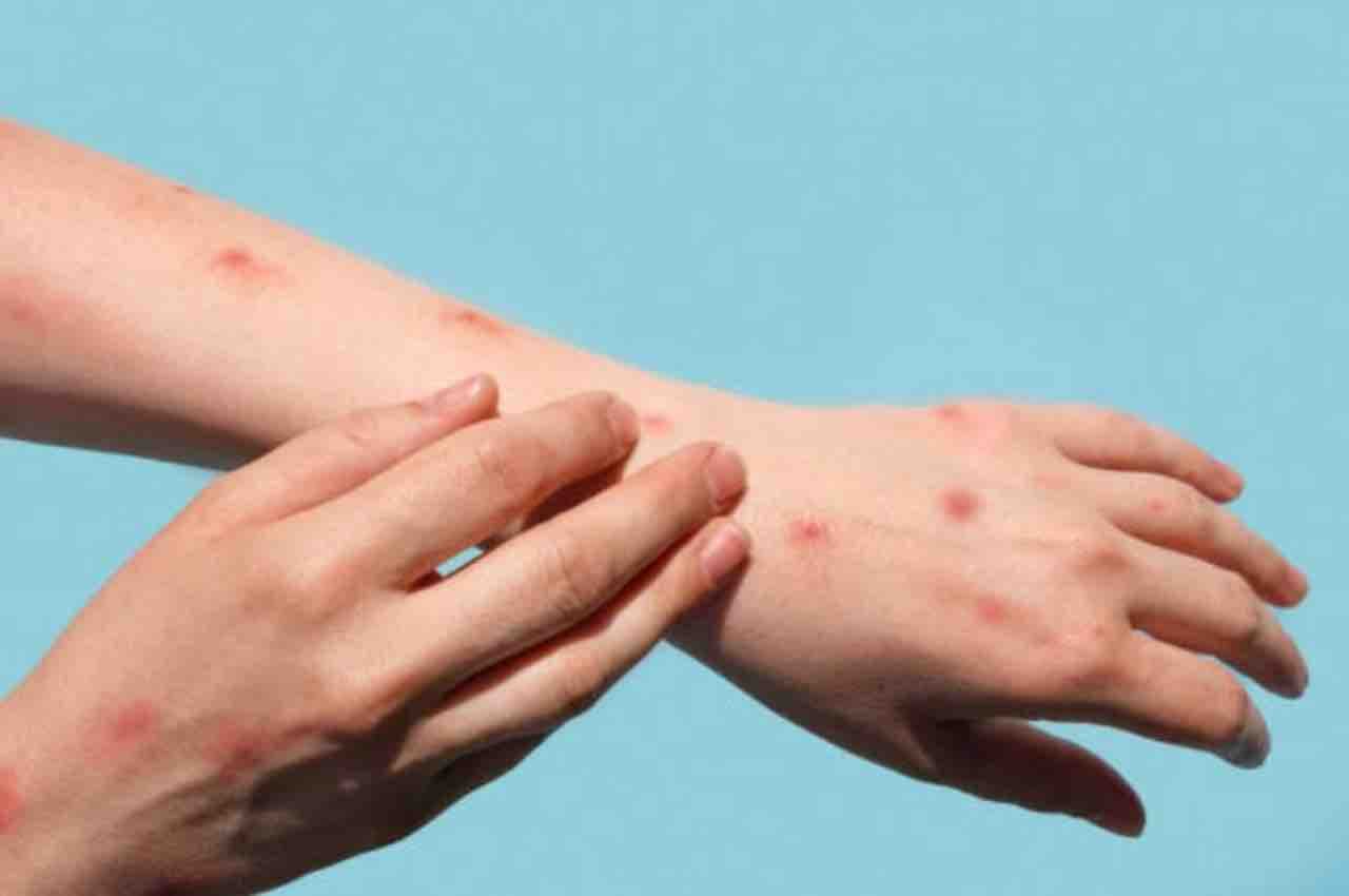 Monkeypox: भारत में मंकीपॉक्स के चार मामले आने के बाद सरकार अलर्ट पर, वैक्सीन निर्माण के लिए उठाया बड़ा कदम