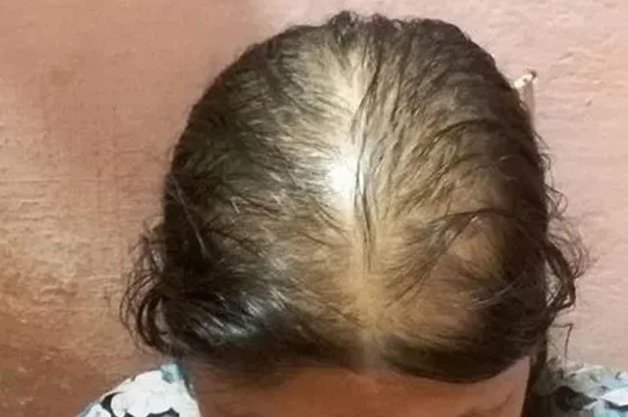 Baldness Treatment: बाल झड़ने से लोग हो जाते हैं गंजेपन का शिकार, बचने के लिए करें ये 3 काम