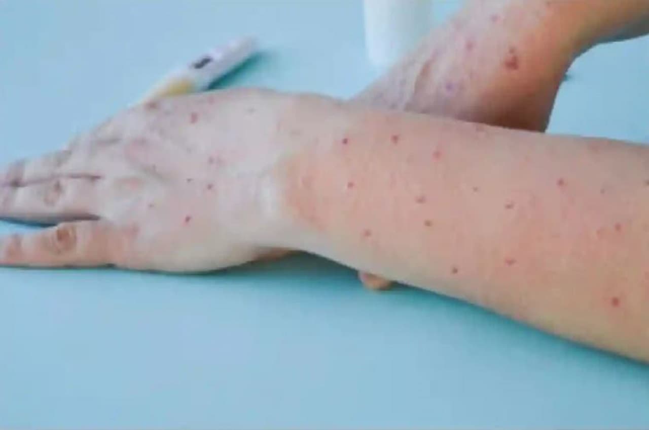 Monkeypox: केरल से हरियाणा पहुंचे व्यक्ति में मिले मंकीपॉक्स के लक्षण, जांच हेतु भेजा गया सैंपल