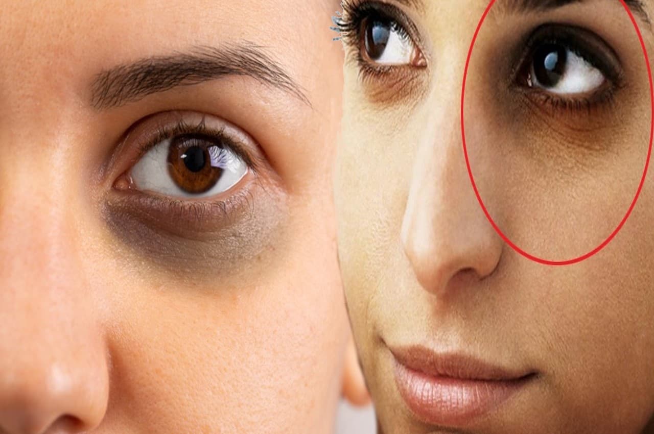 Dark Circles: ये दो चीजें हटा देंगी आंखों के नीचे होने वाले डार्क सर्कल, खूबसूरत दिखेगा फेस...
