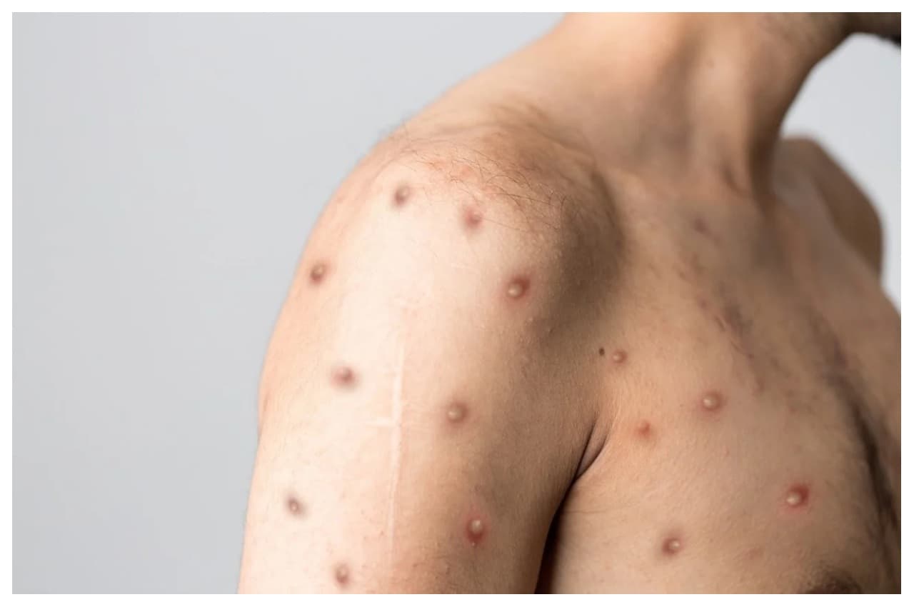 Monkeypox: एक सप्ताह में 20 फीसदी मामले बढ़े, देश में 35 हजार केस