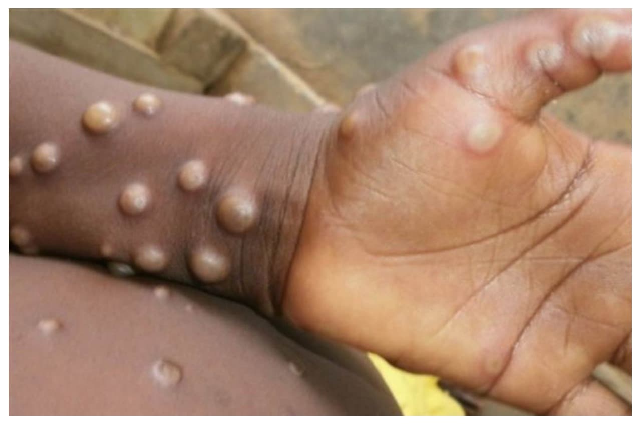 Monkeypox: दिल्ली में पांचवां केस, घर के आसपास बंदर या चूहे तो बरतें यह सावधानी