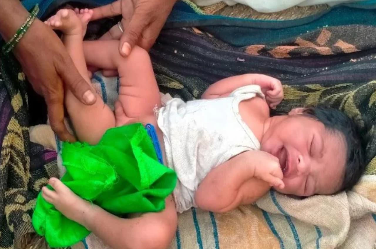 Miracle: शामली में तीन पैर वाले बच्चे ने लिया जन्म, डॉक्टर हैरत में, लोगों ने कहा-दैवीय चमत्कार