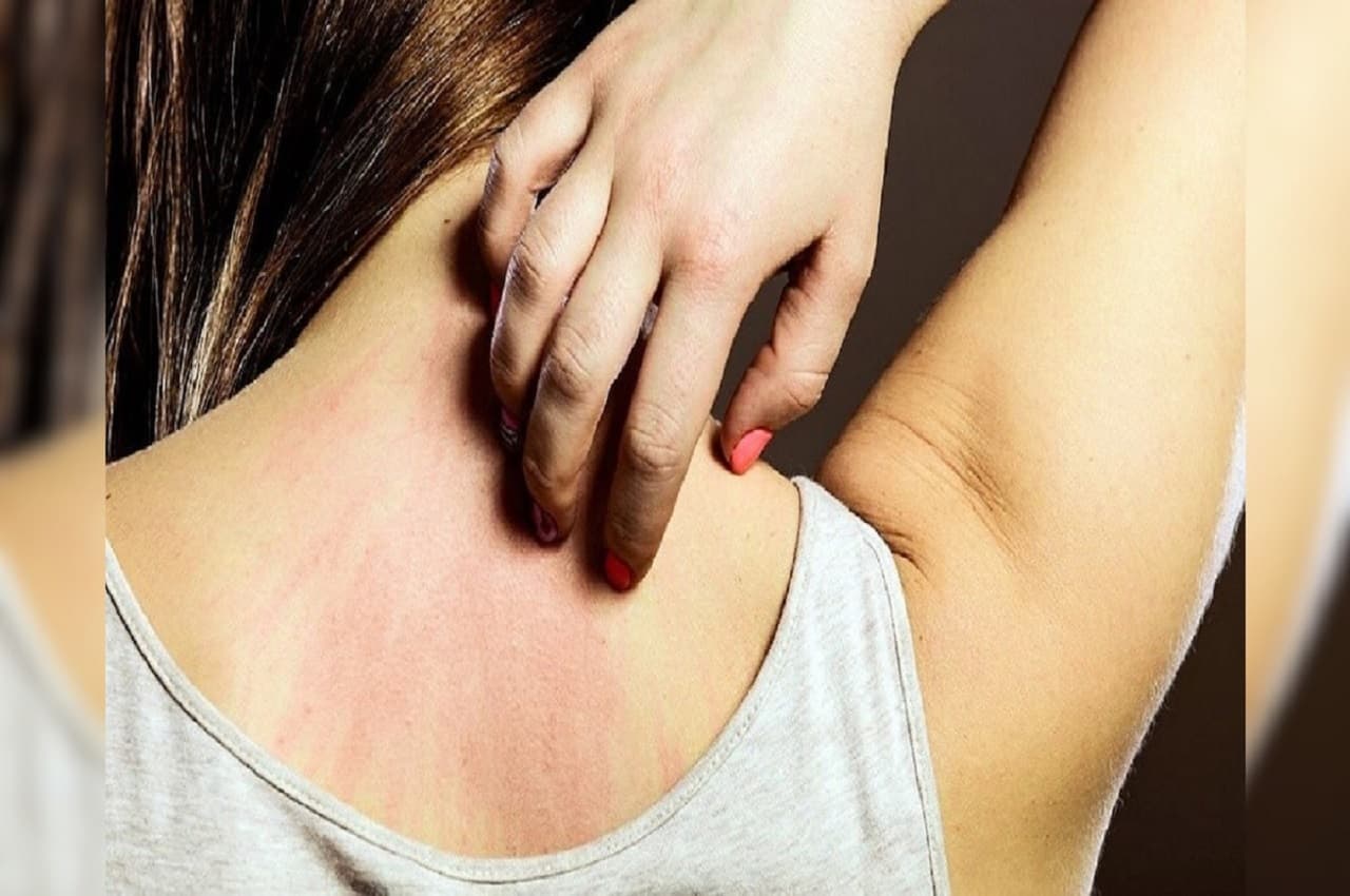 Home Remedies For Itchiness: पानी में डालकर नहाएं ये देसी चीजे, मौसमी खुजली से मिलेगी छुटकारा