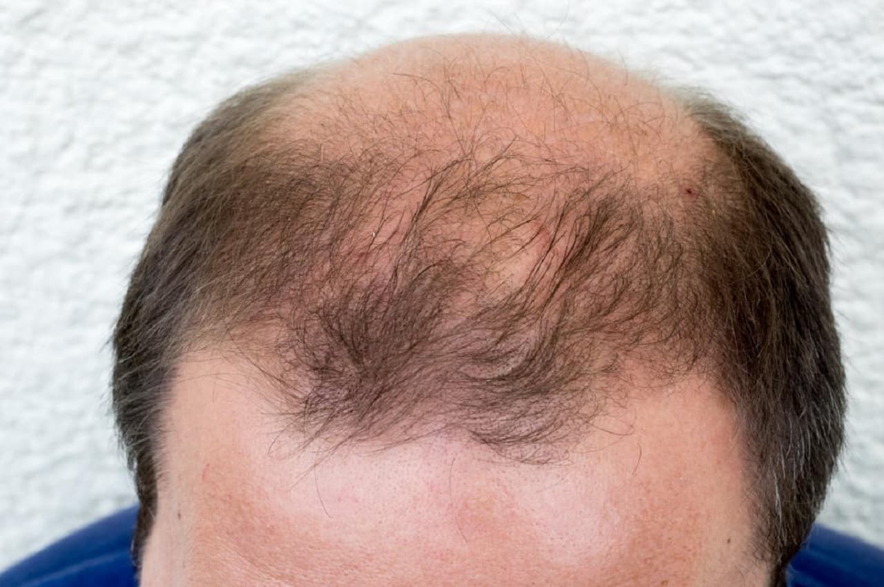 Hair Tips: गंजेपन से हैं परेशान तो बालों ऐसे लगाएं गुड़हल के फूल, फिर देखें कमाल
