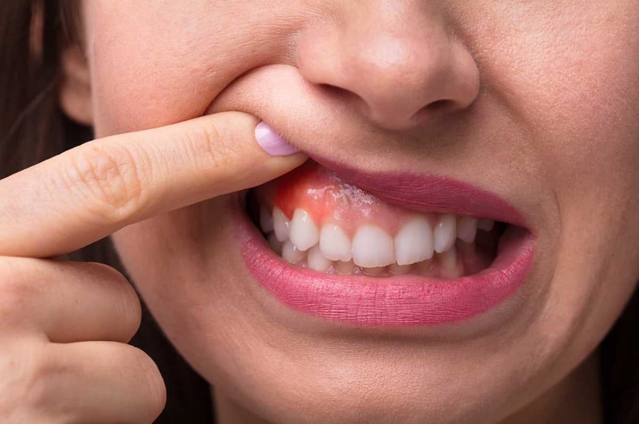 Oral cancer early symptoms: ओरल कैंसर के इन 5 शुरुआती लक्षणों को भूलकर भी न करें नजरअंदाज