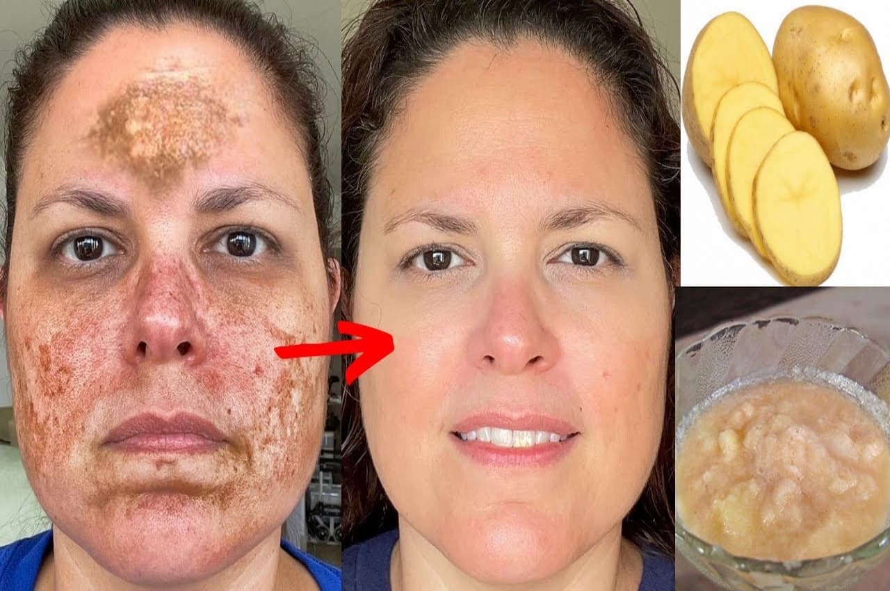 How To Reduce Pigmentation: आलू की मदद से हटाएं चेहरे की पिगमेंटेशन, ये रही इस्तेमाल की सिंपल विधि