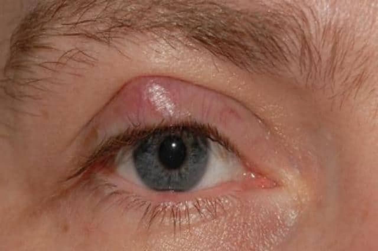 Swelling in Eyelids Causes: क्यों आती है पलकों के ऊपर सूजन? जानें इसके कारण और उपचार के तरीके