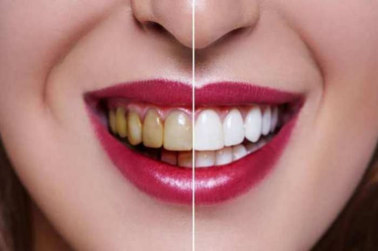 Teeth Whitening Tips: दांतों को मोती की तरह चमकाना चाहते हैं, तो आज ही आजमाएं ये घरेलू उपचार