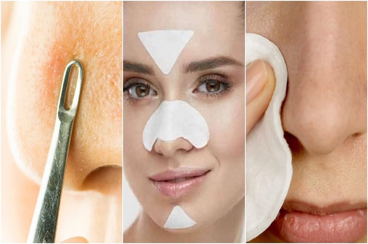 How To Get Rid Of White Heads: चेहरे के व्हाइटहेड्स को आसानी से हटा देती है दही, बस इस विधि को अपनाएं