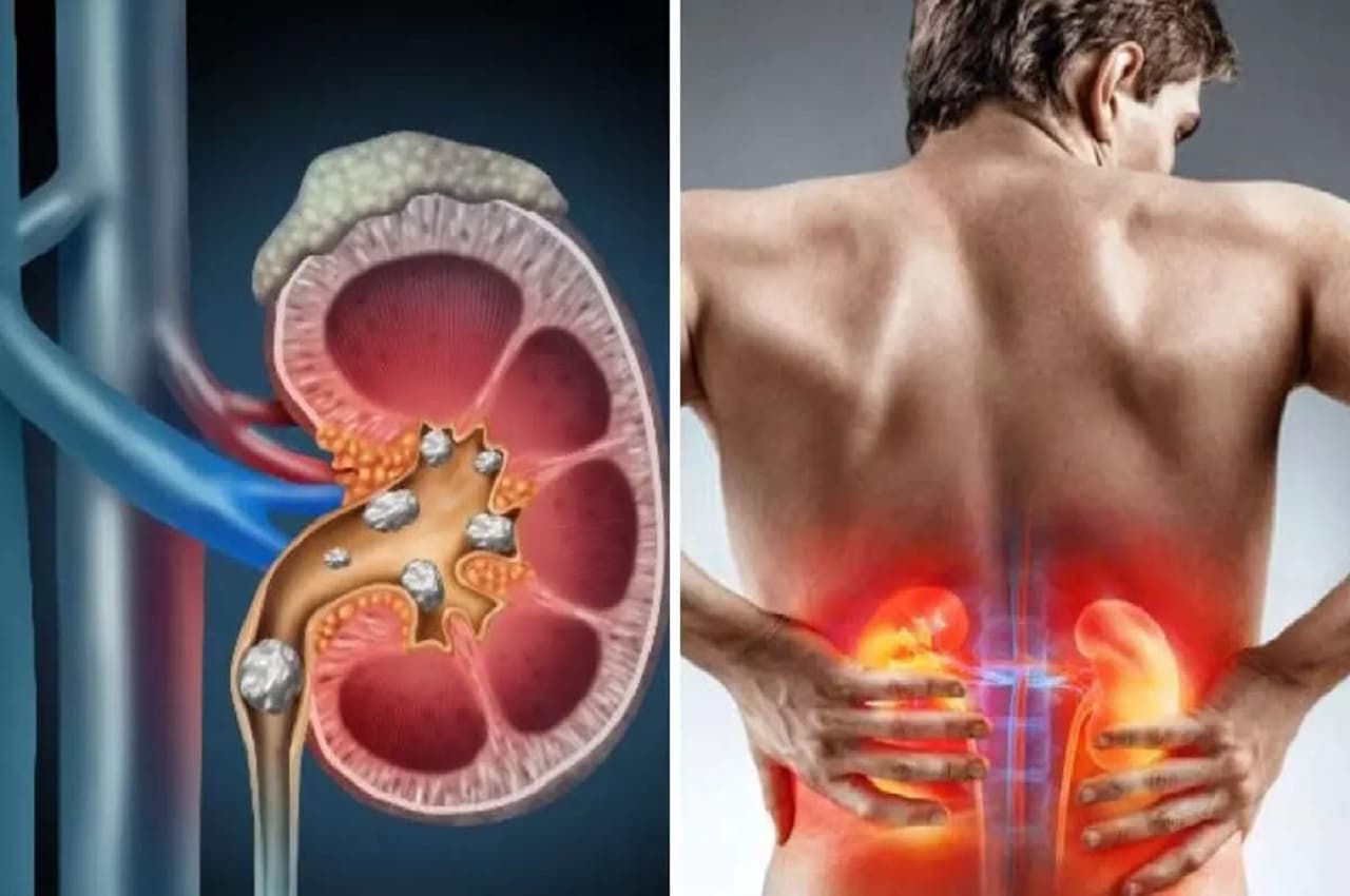 Symptoms Of Kidney Failure: कमर दर्द को साधारण समझने की भूल न करें, हो सकता है किडनी फेलियर का संकेत