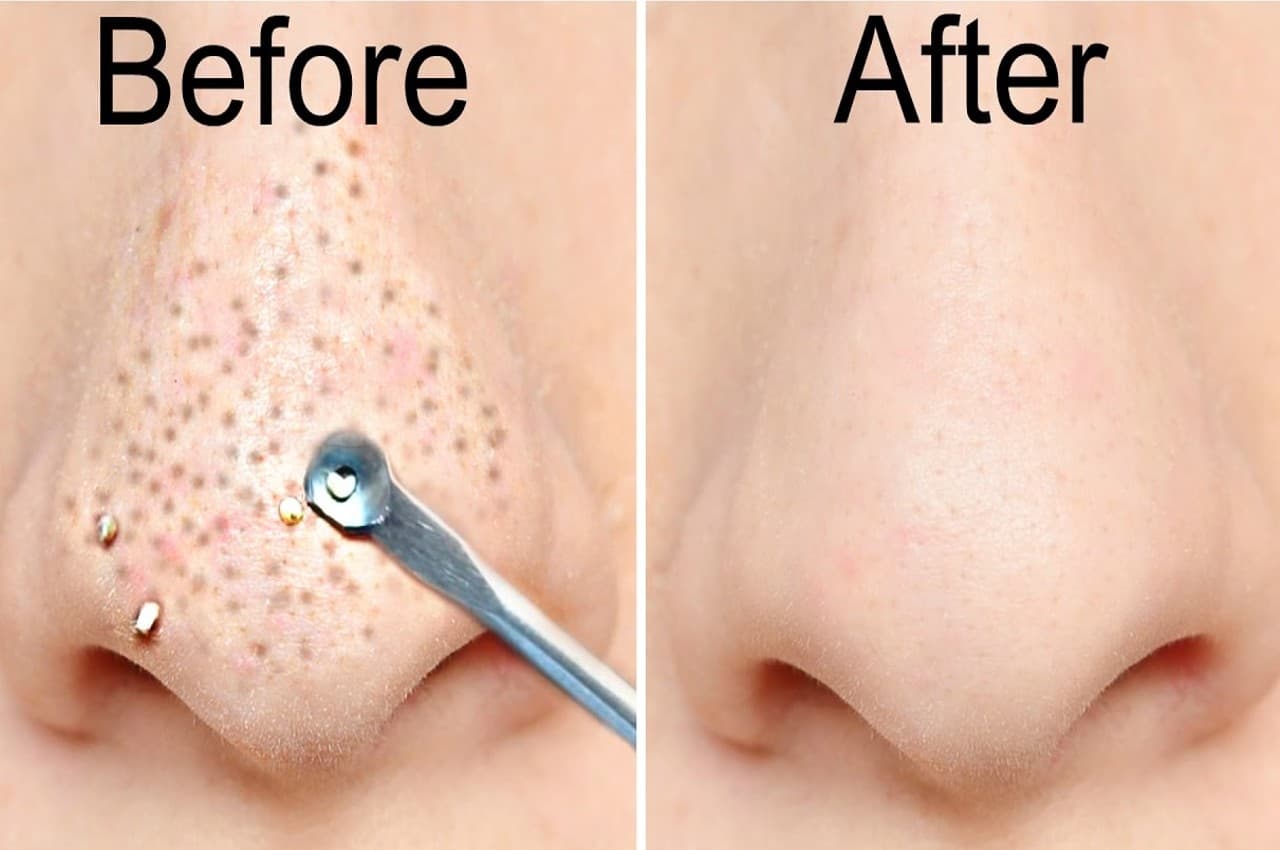 Face Care: फेस के वाइटहेड्स और ब्लैकहेड्स हटा देगी ये खास चीज, बदल जाएगी रंगत