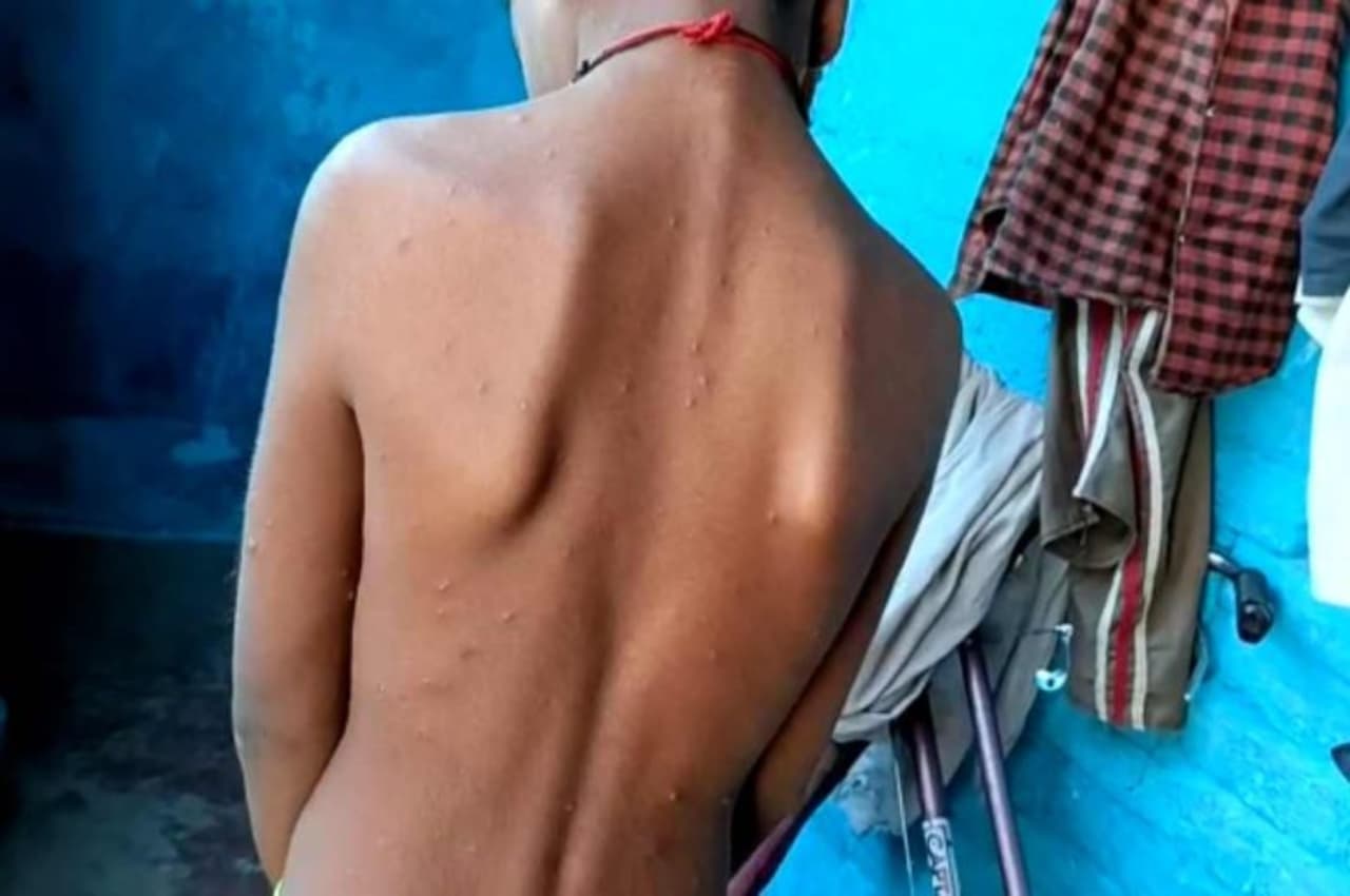 MP के इस जिले में चिकन पॉक्स ने दी दस्तक, 4 दर्जन से अधिक बच्चों के लिए गए सैंपल