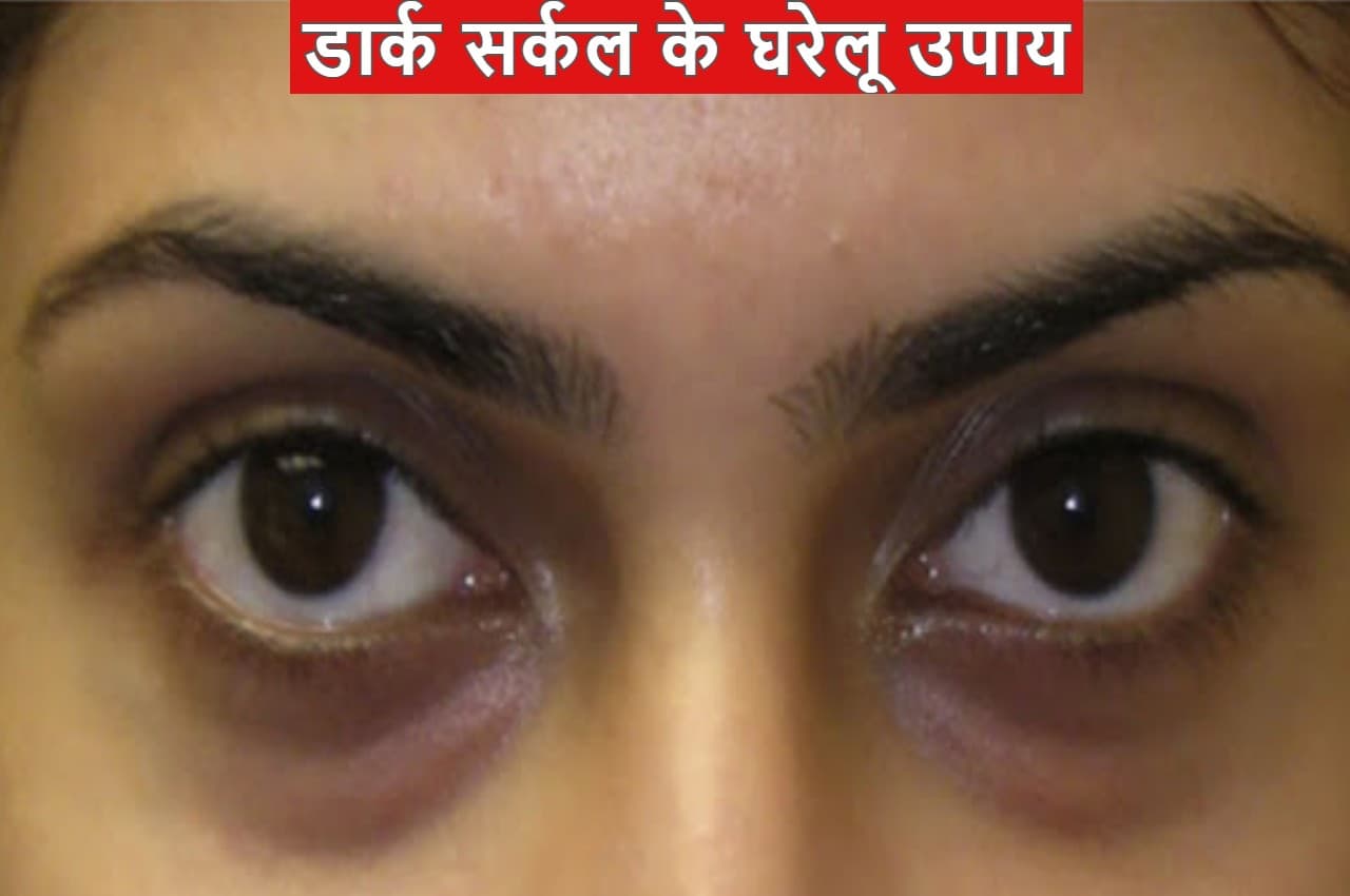 Dark Circles Home Remedies: आंखों के नीचे काले घेरे करते हैं परेशान? इन घरेलू उपायों से होगा डार्क सर्कल्स का इलाज