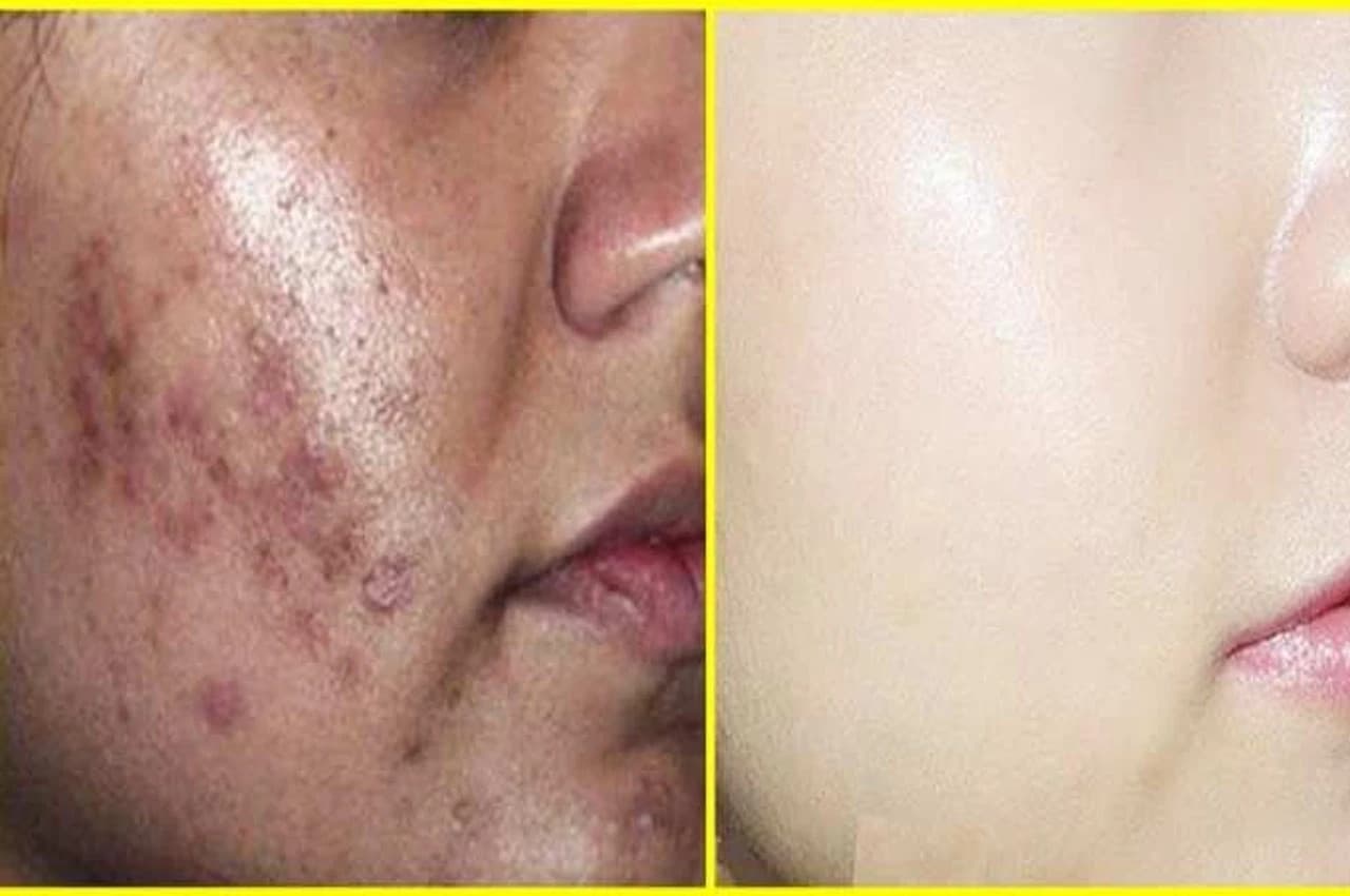 Skin care TIPS: दही में मिलाकर चेहरे पर लगाएं ये चीज, ऑयली स्किन-डेड सेल्स होगी गायब, मिल जाएगा मनचाहा निखार