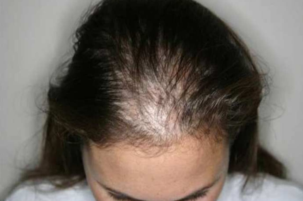 Hair Fall Stop: रोज झड़ रहे बालों से निजात दिलाएगा ये मेथी का घरेलू नुस्खा, जड़ से मिलेगी मजबूती, हेयर हो जाएंगे शानदार