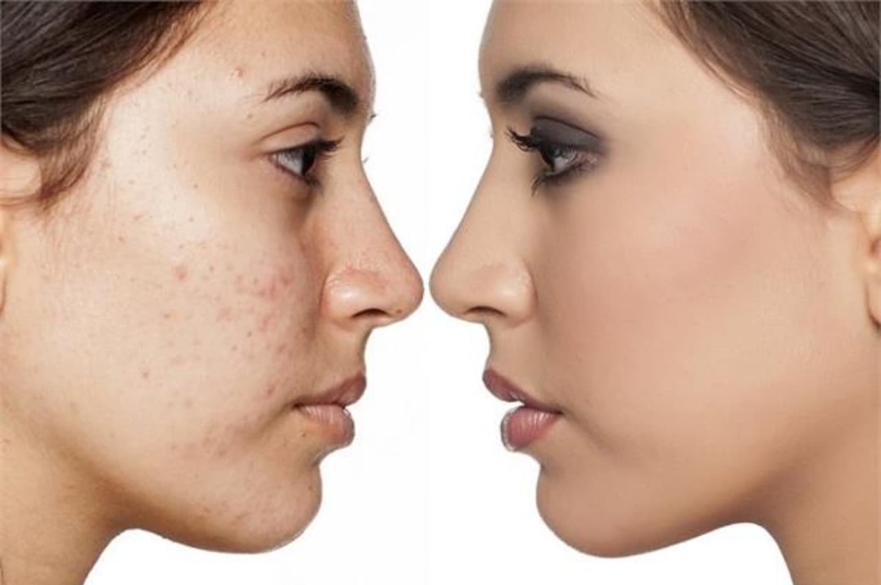 Skin Care TIPS: चेहरे के पिंपल्स, दाग-धब्बों को खत्म कर देगी ये चीज, बस हफ्ते में 2 बार लगाएं, चमक जाएगा फेस