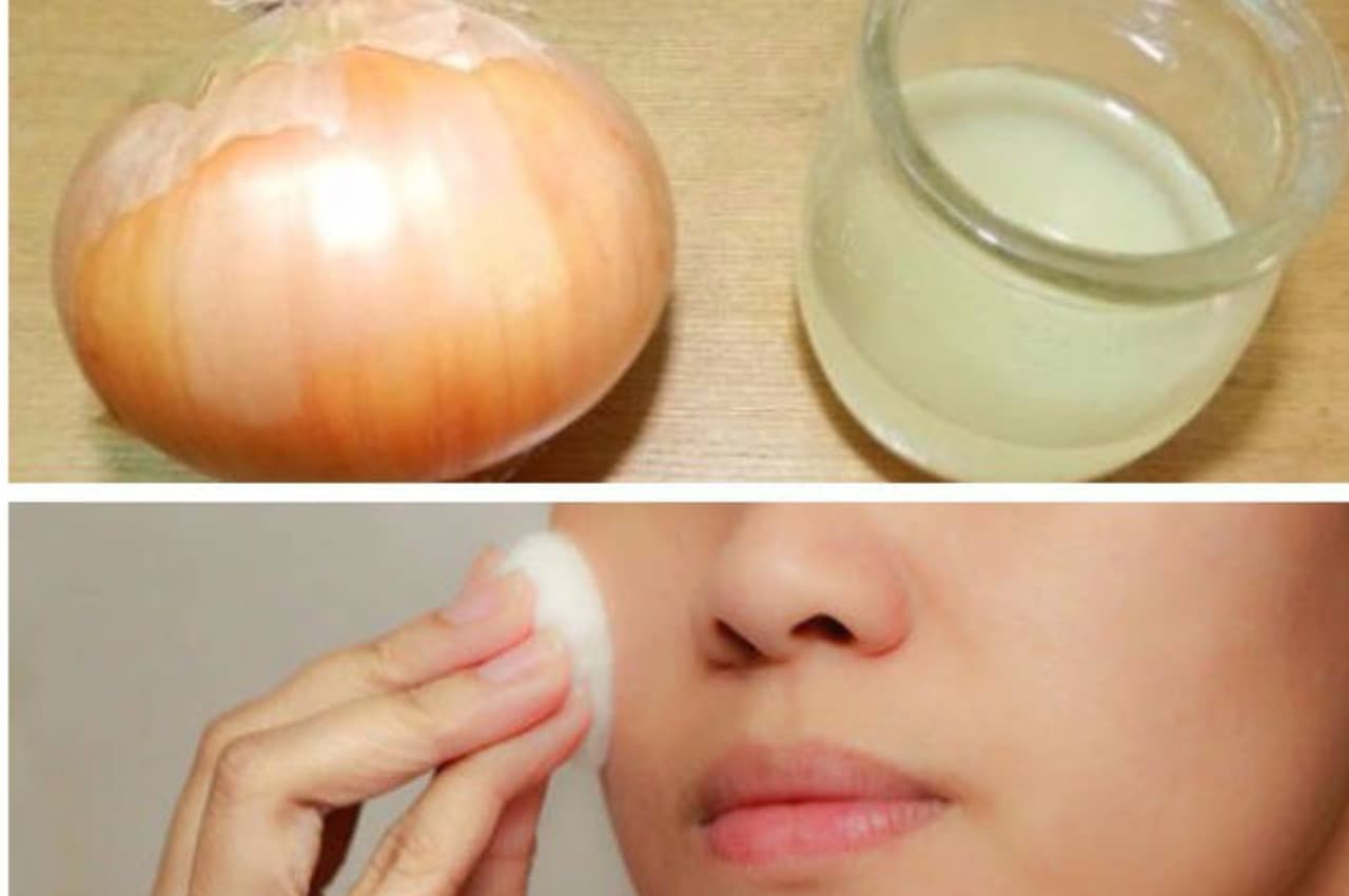 Skin care TIPS: दाग-धब्बे, पिंपल और पिंगमेंटेशन गायब कर देगी प्याज, मिलेगा शानदार निखार