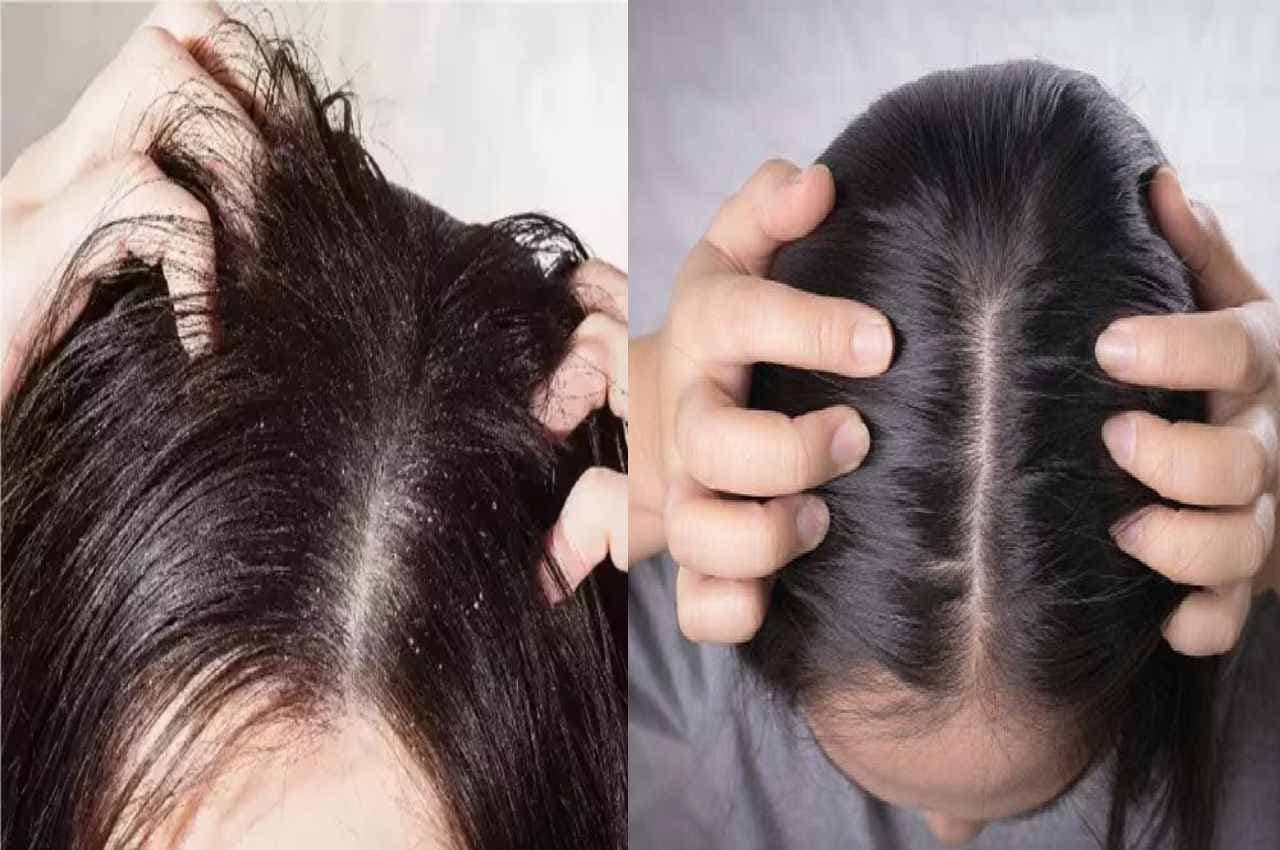 Dandruff Treatment: रात के वक्त बालों में लगाएं ये खास चीज...दूर भाग जाएंगे Dandruff, हेयर बनेंगे घने-मजबूत