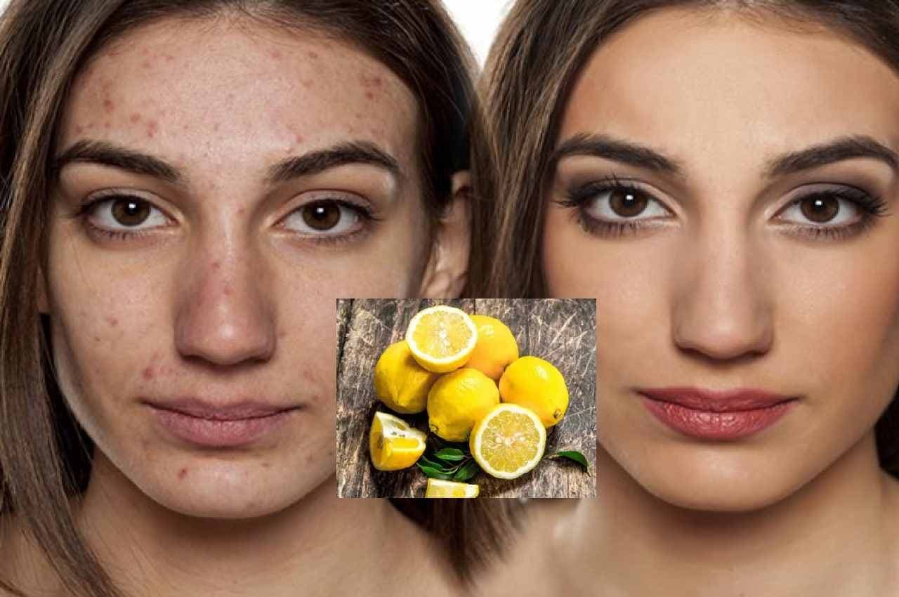 Skin care TIPS: 1 नींबू के घरेलू नुस्खे देंगे जबरदस्त निखार, चेहरे के पिंपल-एक्ने रातों-रात होंगे गायब