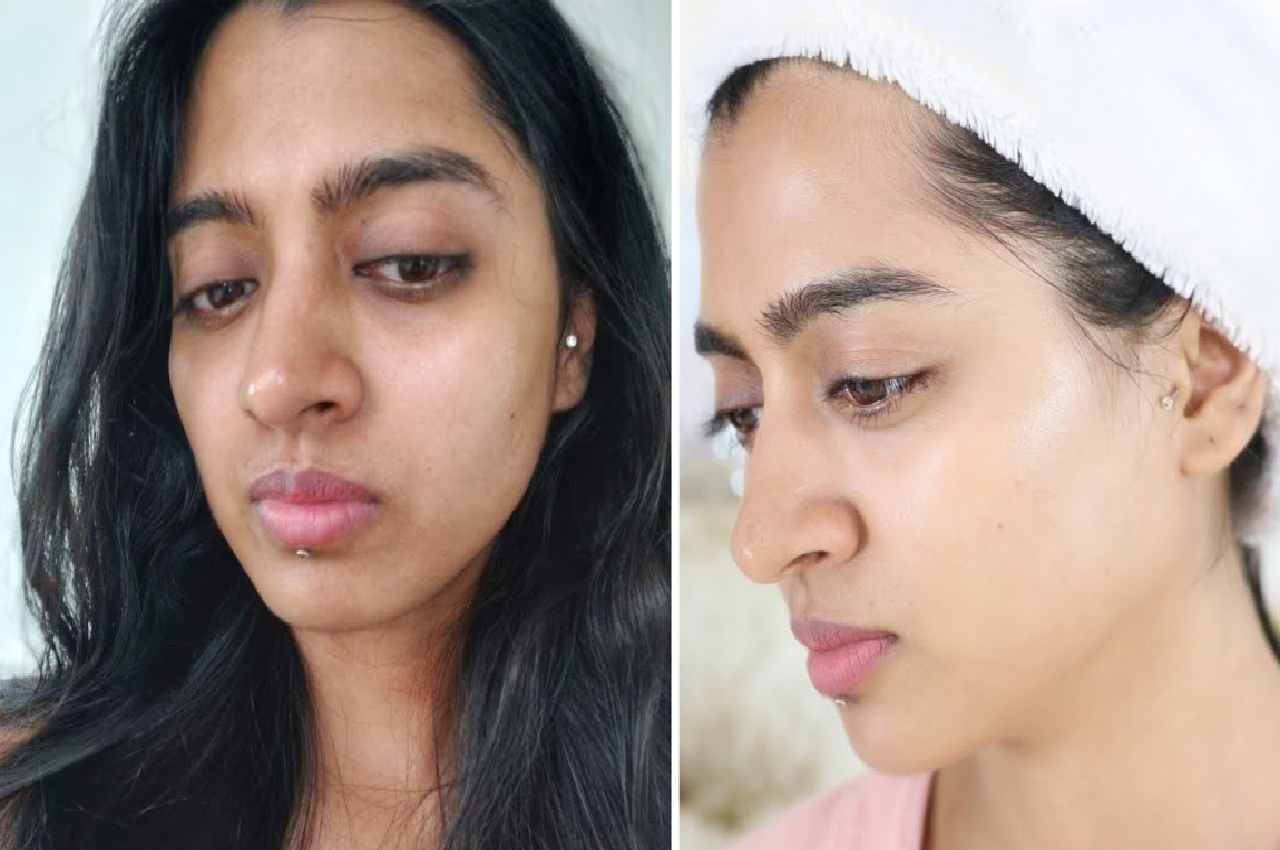 Spotless Face TIPS: हफ्ते में 2 बार लगाएं ये चीज...गायब होंगे कील-मुंहासे..दाग-धब्बे...दमकने लगेगा चेहरा