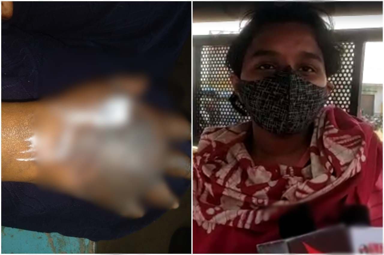 जज्बे को सलाम; एसिड अटैक के दूसरे दिन जला हुआ हाथ लेकर 10वीं की परीक्षा देने पहुंची छात्रा, फिर...