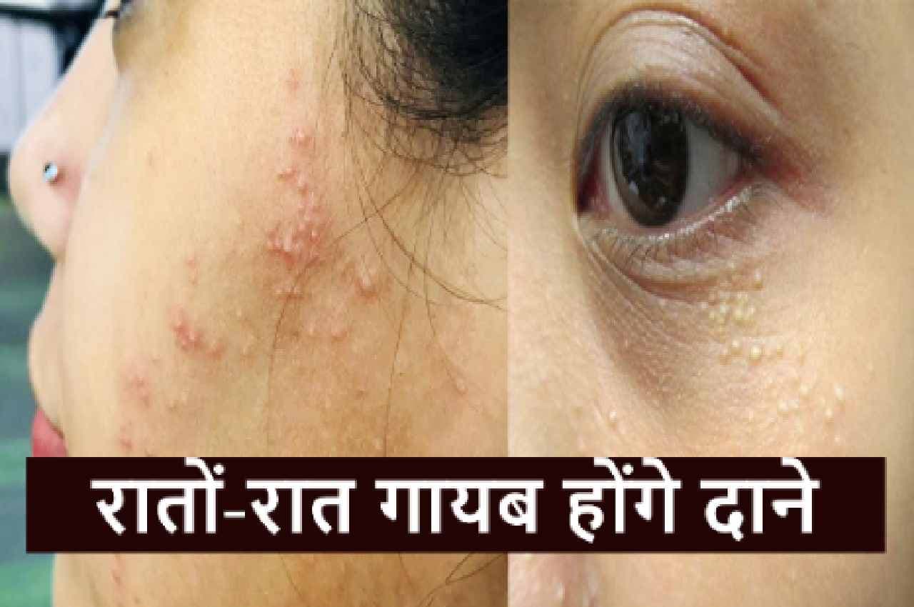 Glowing Skin TIPS: एक-एक दाने और धब्बे हटाकर चेहरे को सॉफ्ट बना देगा ये नुस्खा...मिलेगा मनचाहा निखार