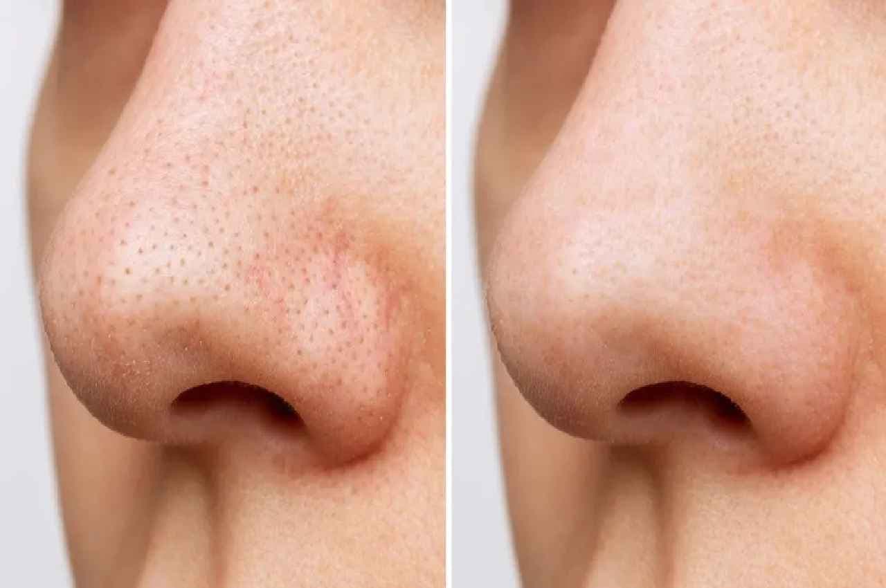 Skin care TIPS: ये चीज रातों-रात गायब कर देगी Blackheads...खिल उठेगा आपका चेहरा