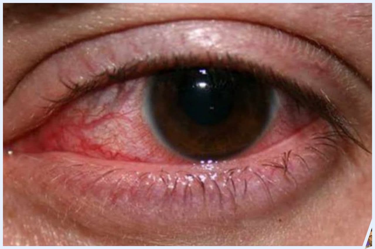 एम्स के Eye Specialist ने दूर किया भ्रम, आईफ्लू वाले की आंख देखने से नहीं फैलता ये वायरस