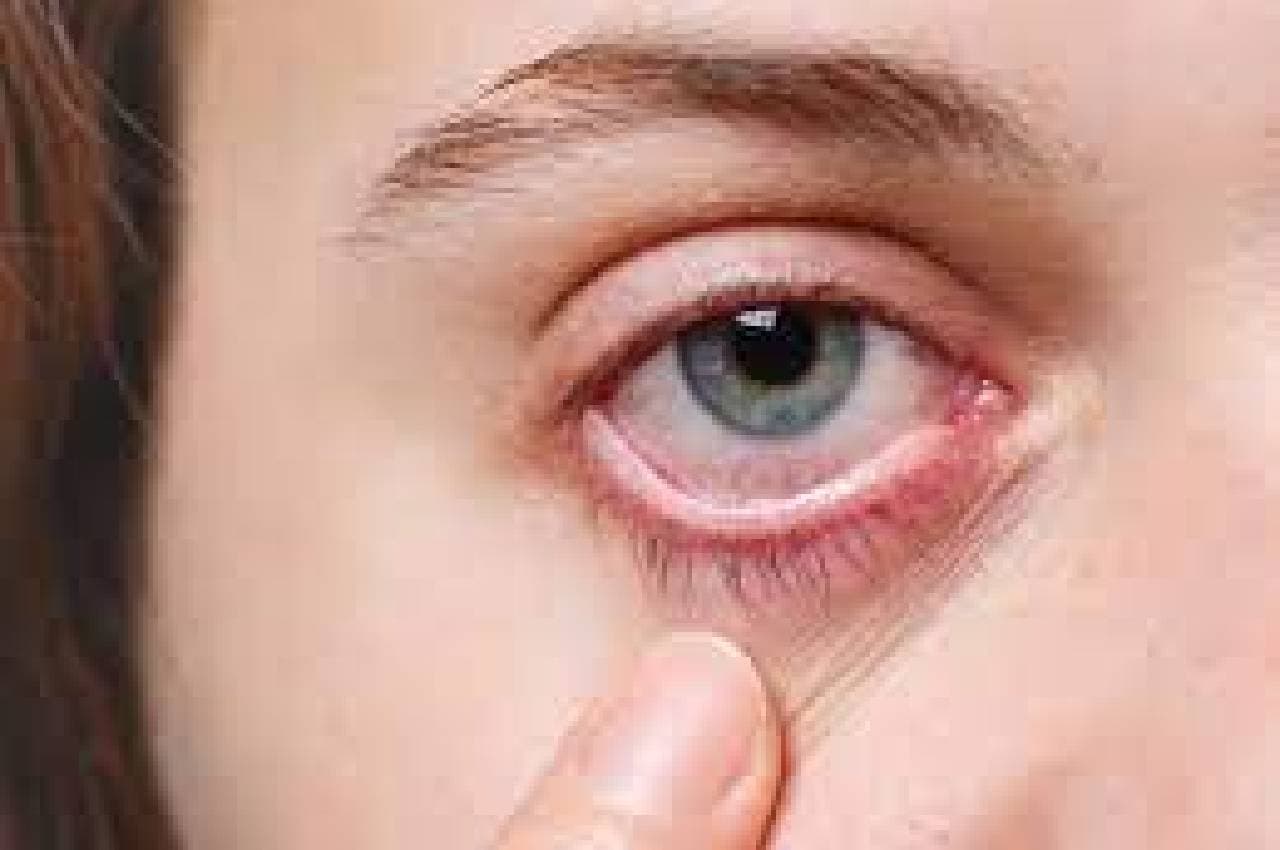 MP में Eye Flu का कहर, हर दिन बढ़ रही मरीजों की संख्या, ऐसे करें बचाव