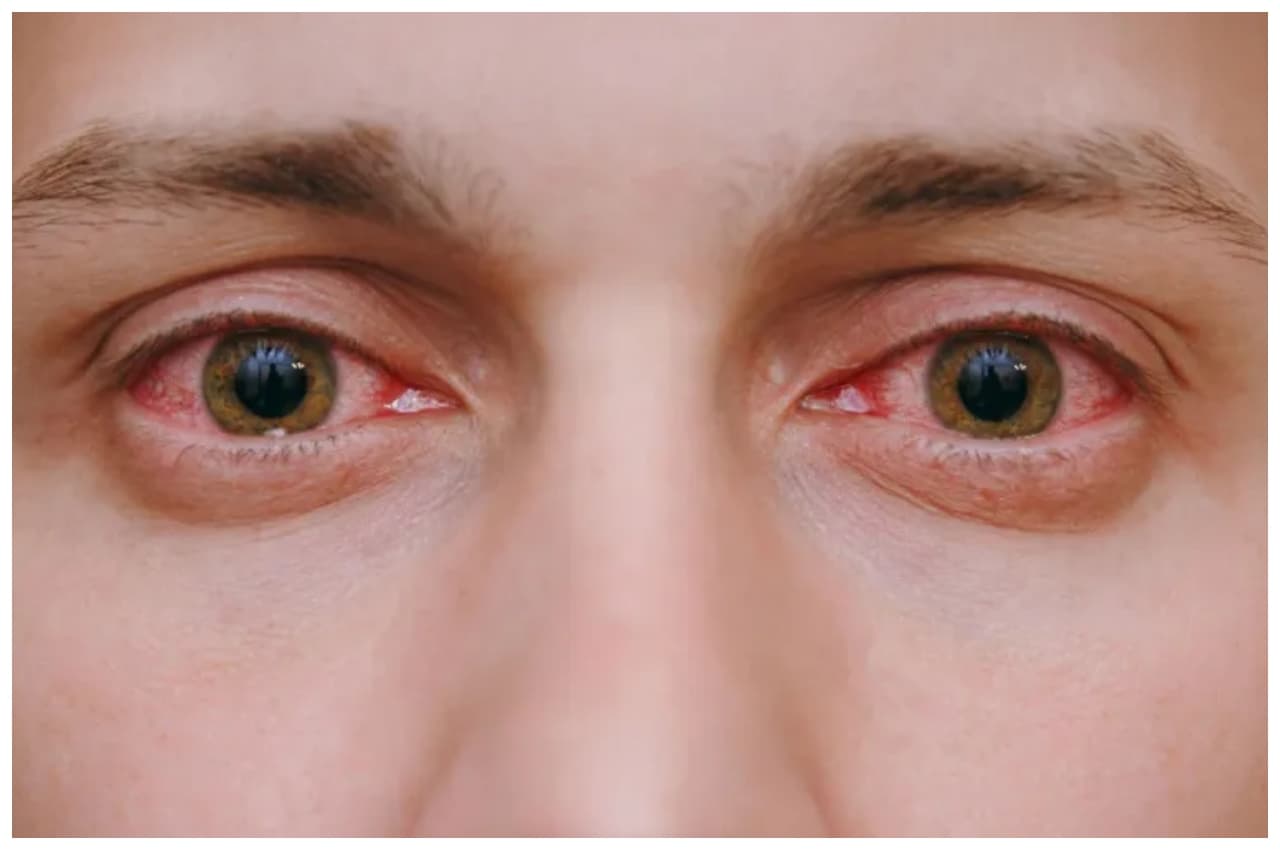 Eye Flu: आई फ्लू से बचाव के लिए अपनाएं ये घरेलू उपाय, जलन और दर्द से मिलेगी राहत