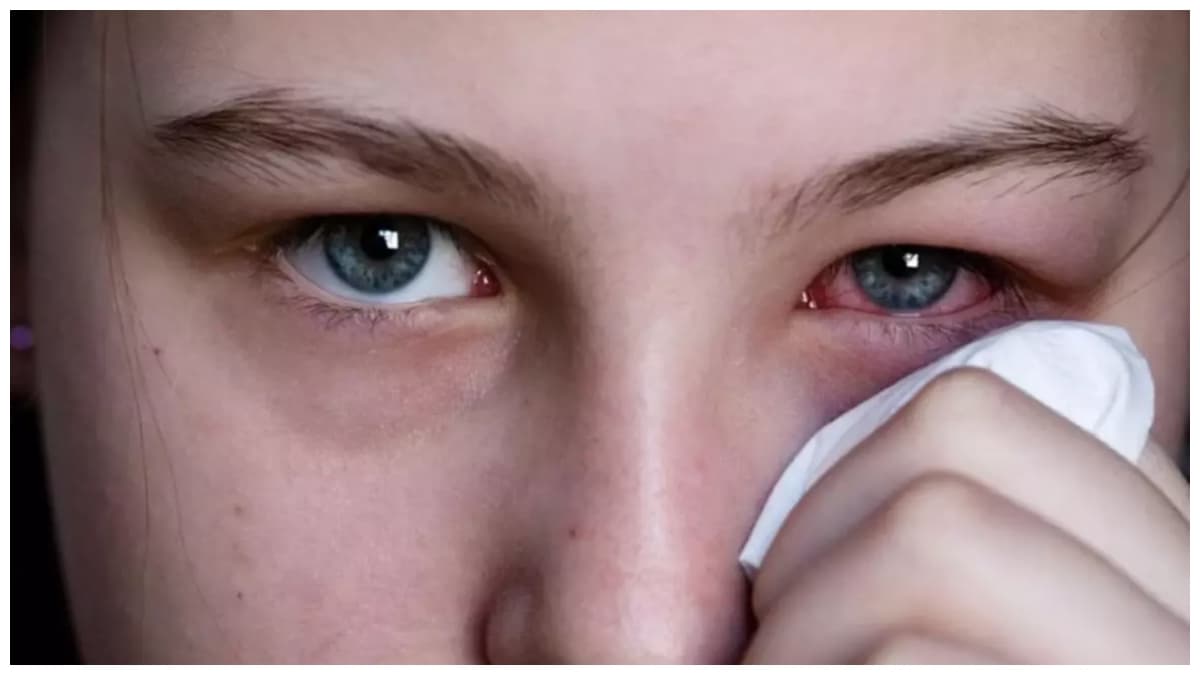 Eye Flu Precautions: अगर हो गया है आई फ्लू तो भूलकर भी नहीं करें ये गलतियां, नहीं तो भुगतने पड़ सकते हैं गंभीर परिणाम