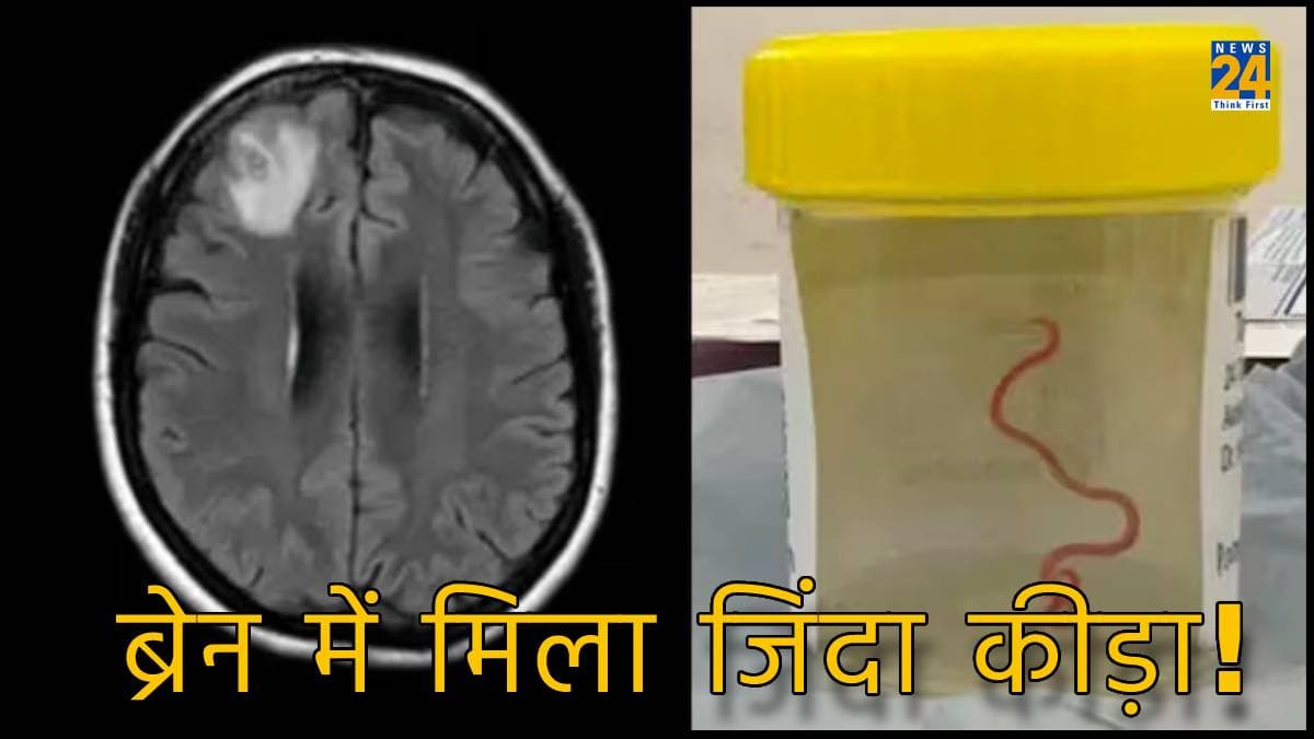 महिला के दिमाग में कैसे पहुंचा सांपों में मिलने वाला कीड़ा, डाक्टर्स के उड़े होश