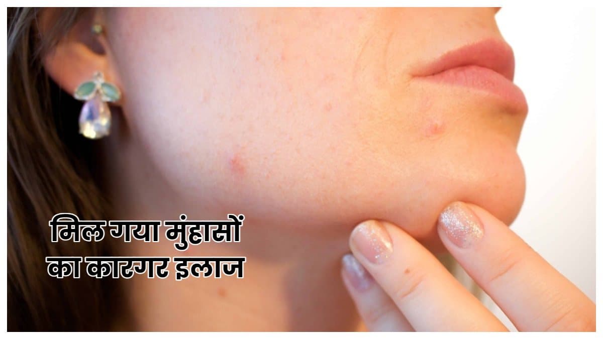 मुंहासों का भी कारगर इलाज है बर्थ कंट्रोल पिल्स, लेकिन रखनी होगी ये सावधानी