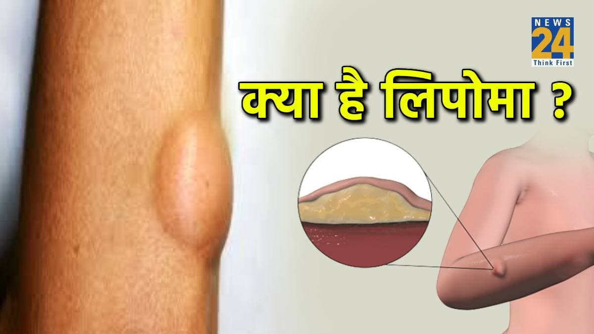 Lipoma का चर्बी से क्या है नाता, कैसे हो सकता है खतरनाक! जानें कारण और इलाज