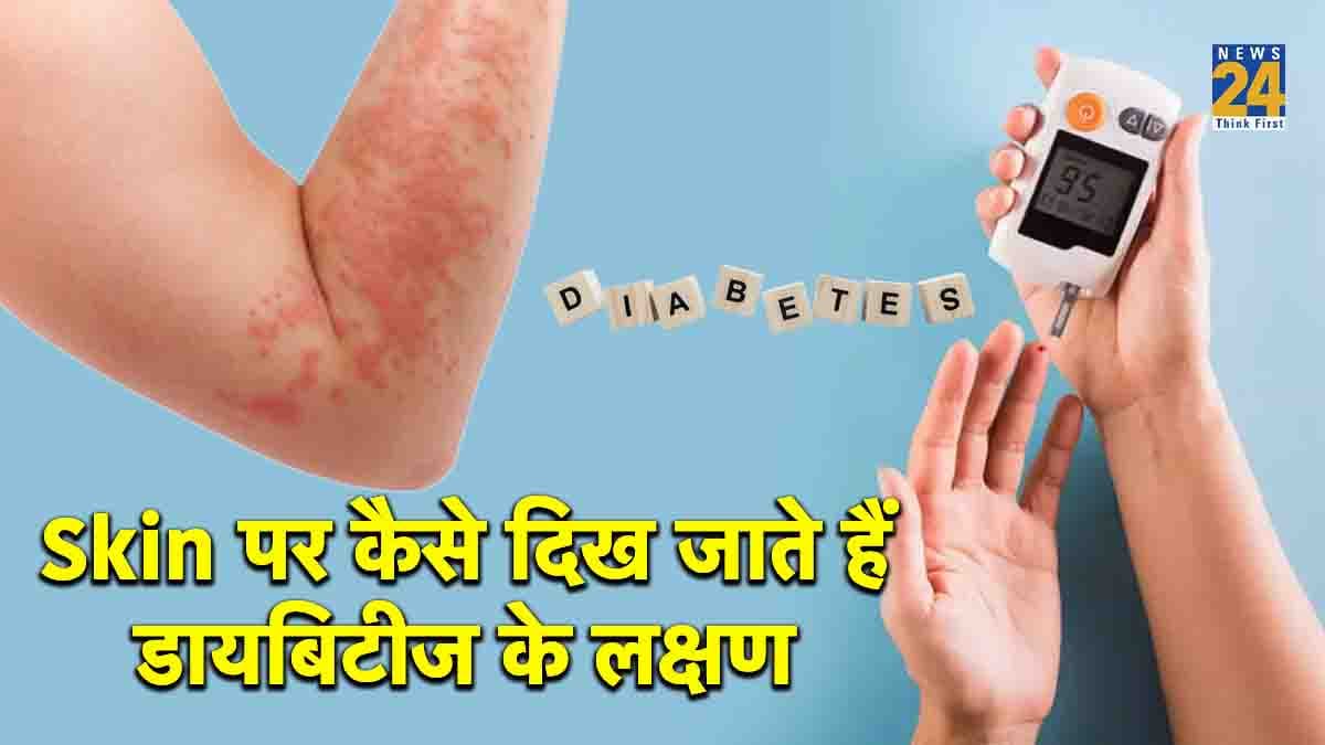 Diabetes में हो सकती है स्किन की बीमारी, नहीं दिया ध्यान तो भुगतने होंगे ये गंभीर नुकसान