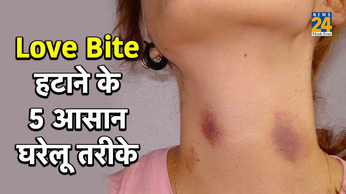 क्या लव बाइट से होना पड़ता है शर्मिंदा? तो मिनटों में ऐसे पाएं छुटकारा