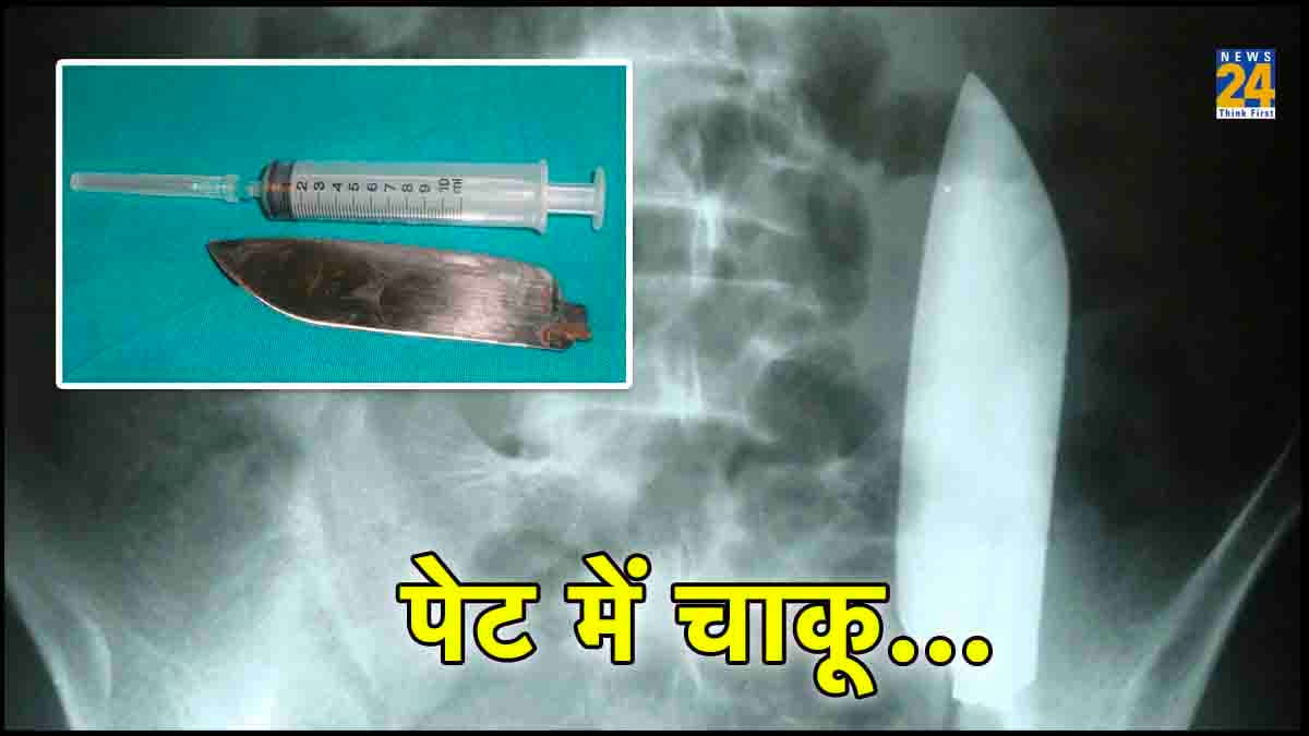युवक के पेट से निकला 15 सेमी लंबा चाकू, Xray देख डॉक्टर बोले- भाई तू जिंदा कैसे है?