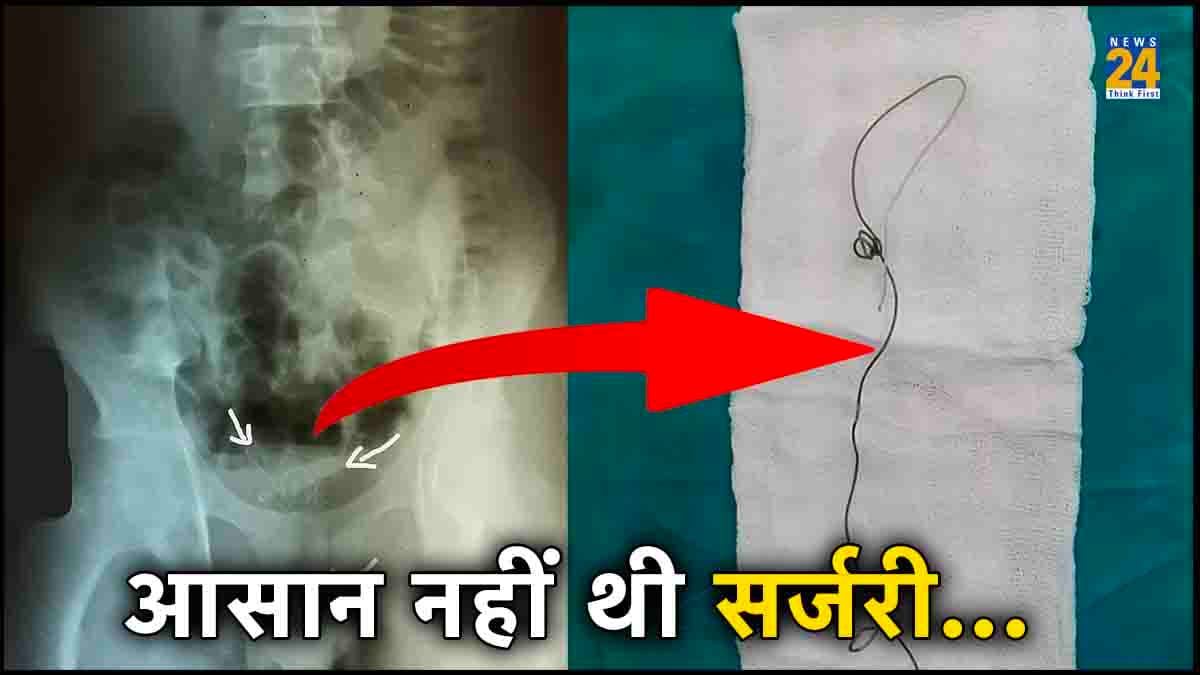17 साल के लड़के को लगी खौफनाक लत, प्राइवेट पार्ट में घुसा लिया 8 इंच लंबा बिजली का तार