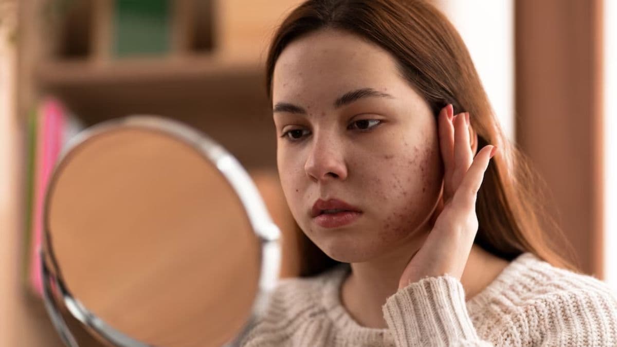 Skin Care Tips: चेहरे पर हो गई हैं झाइयां? इन चीजों का सेवन करके पाएं छुटकारा