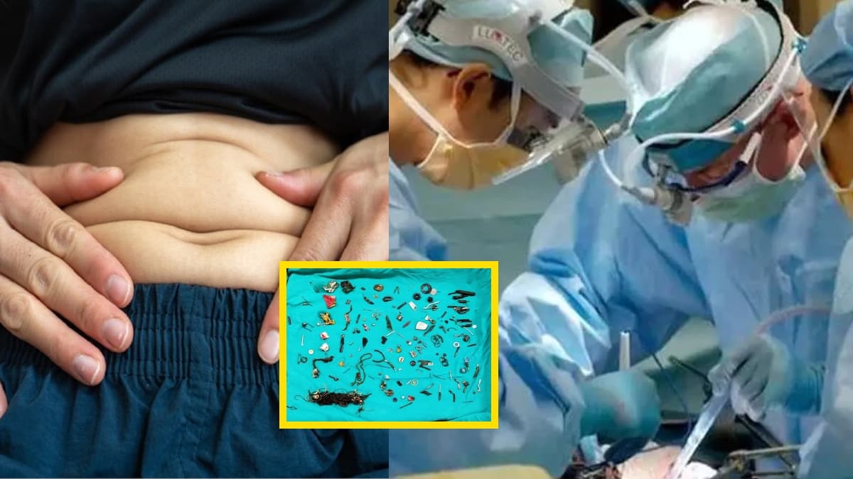 2 साल से दर्द था, सर्जरी में पेट से निकली ऐसी चीजें, देखकर डॉक्टर्स भी कह उठे Oh My God!