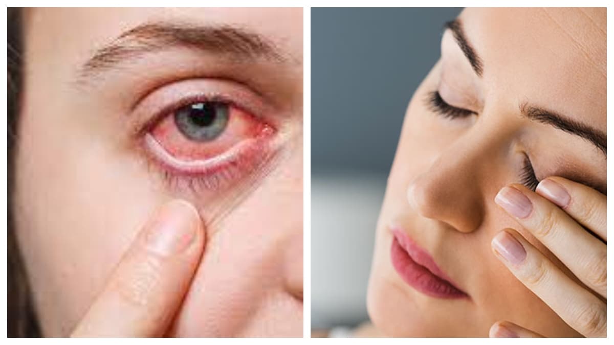 EyeTwitching: क्यों फड़कती हैं आंखें? इनके 4 कारण