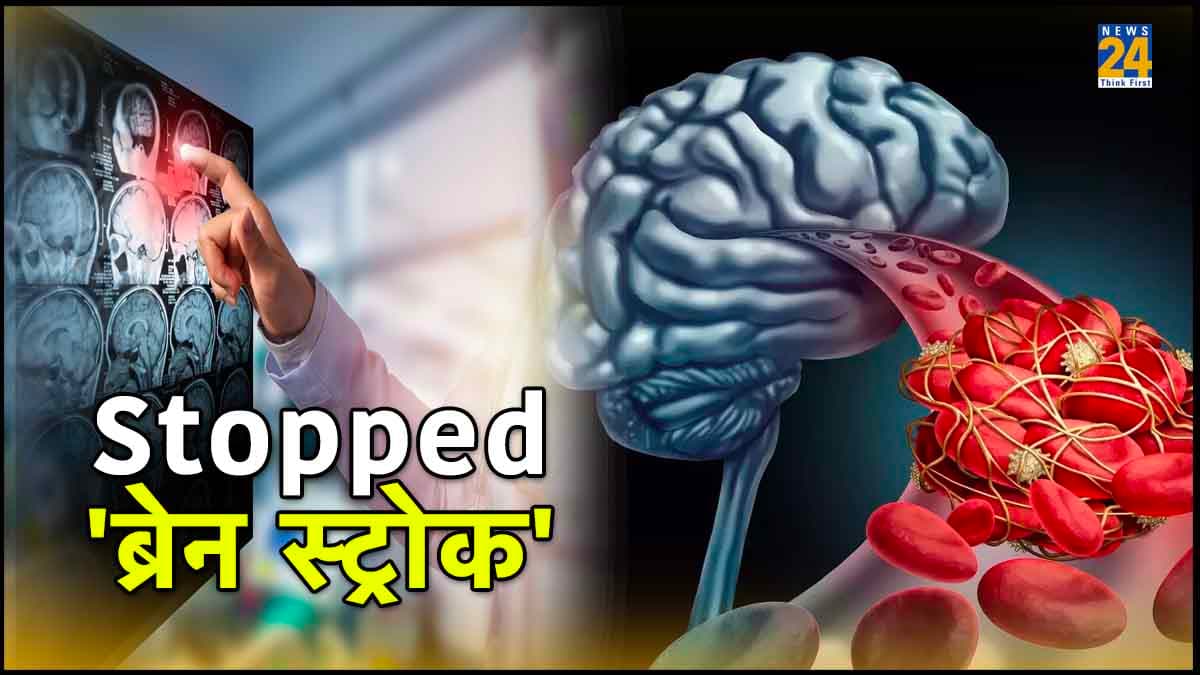 ब्रेन स्ट्रोक क्या है और इसके जोखिम को कैसे रोकें?