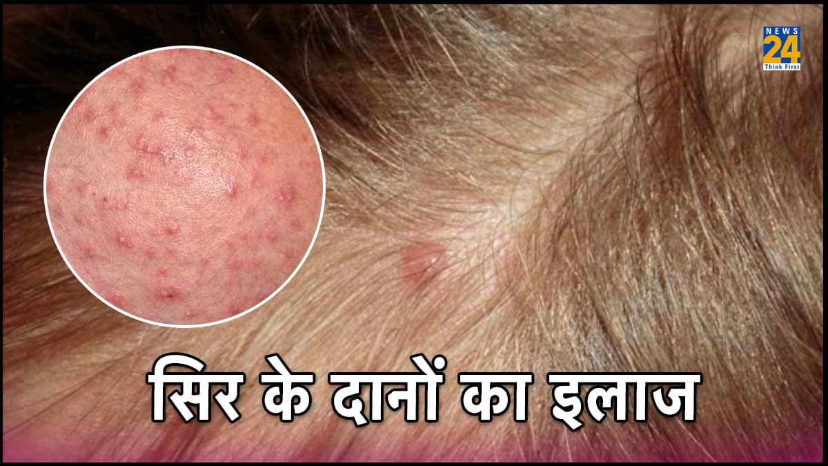सिर में होने वाले दानों और फुंसियों को कहें बाय-बाय, इन 4 नेचुरल उपायों का करें इस्तेमाल