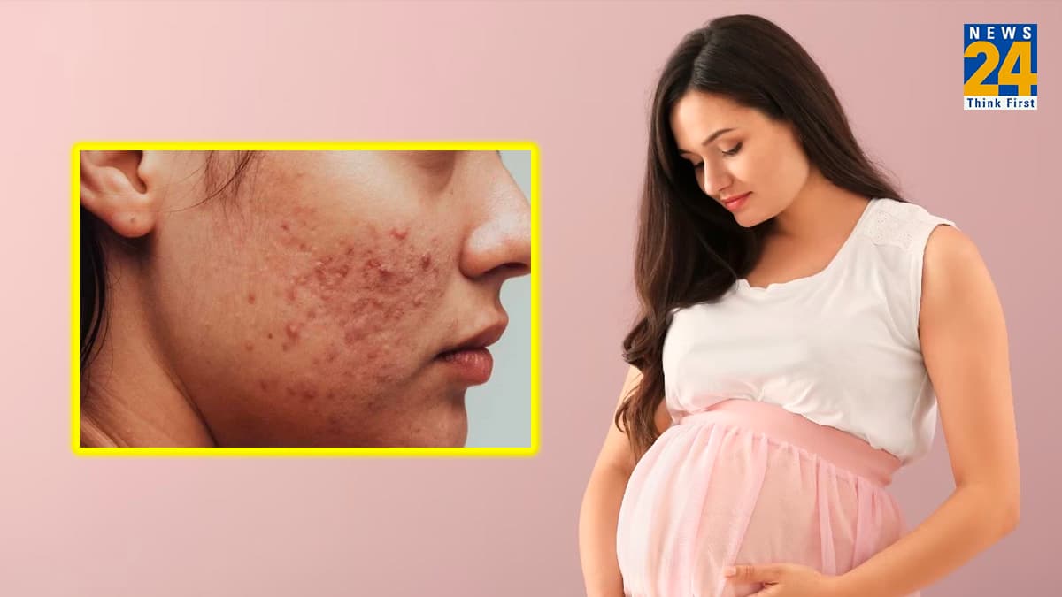 प्रेग्नेंसी में पिंपल्स और एक्ने की प्रॉब्लम का इलाज, 3 घरेलू हैक्स के साथ