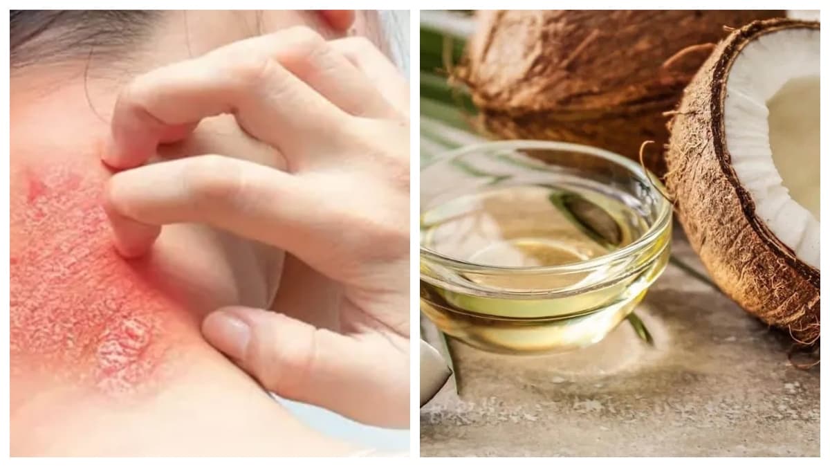 Beauty Tips: रैशेज और इचिंग से परेशान, इन 3 नेचुरल टिप्स से पाए आराम