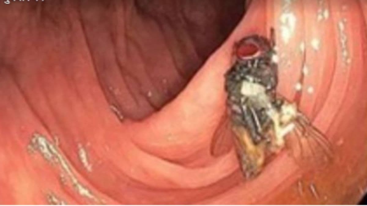 OMG! बुजुर्ग के पेट में आराम फरमाती मिली मक्खी; कैंसर की जांच में कैमरा अंदर डाला तो आई हैरान कर देने वाली कहानी सामने