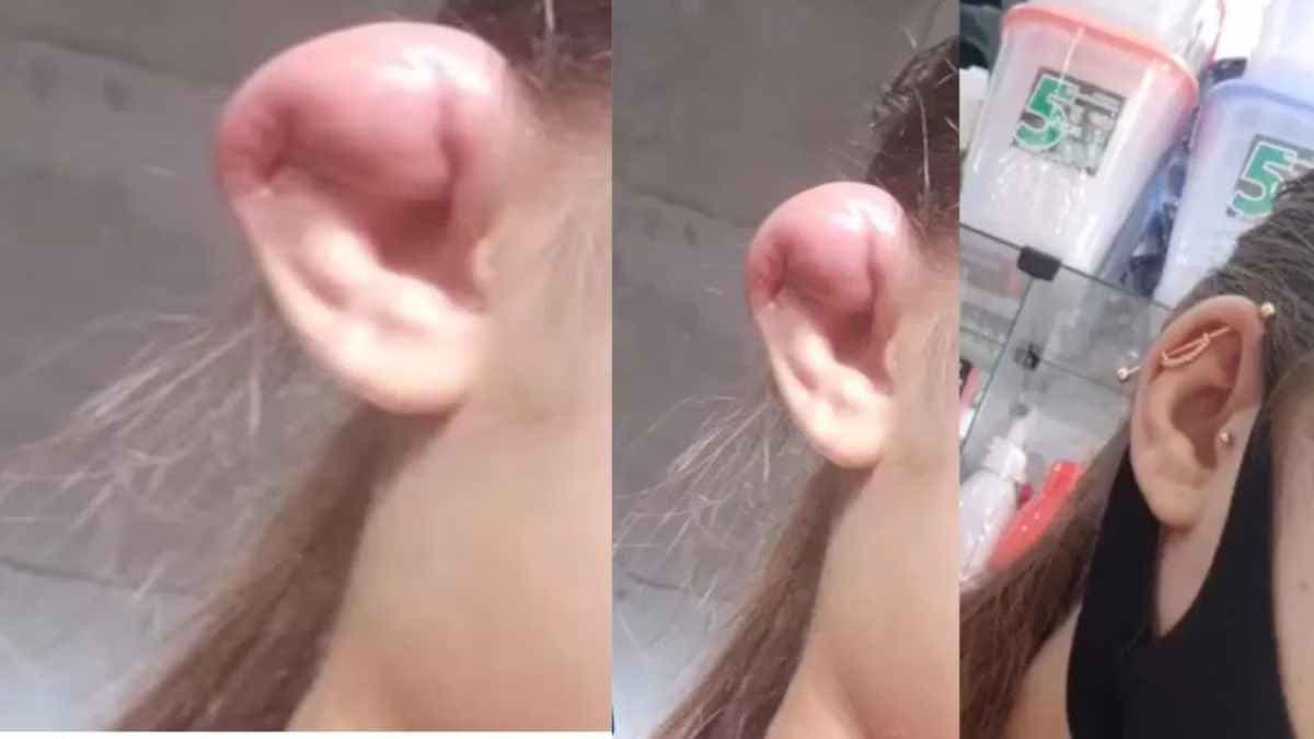 OMG! शौक पड़ा भारी; सूजन आई तो डॉक्टर ने लड़की का कान ही काट डाला