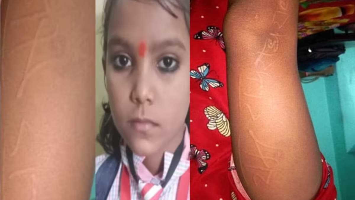 चमत्कार या विज्ञान! यूपी में छात्रा के शरीर पर अचानक दिखने लगा 'भगवान का नाम', अस्पताल पहुंचे तो डॉक्टर भी हुए हैरान, VIDEO